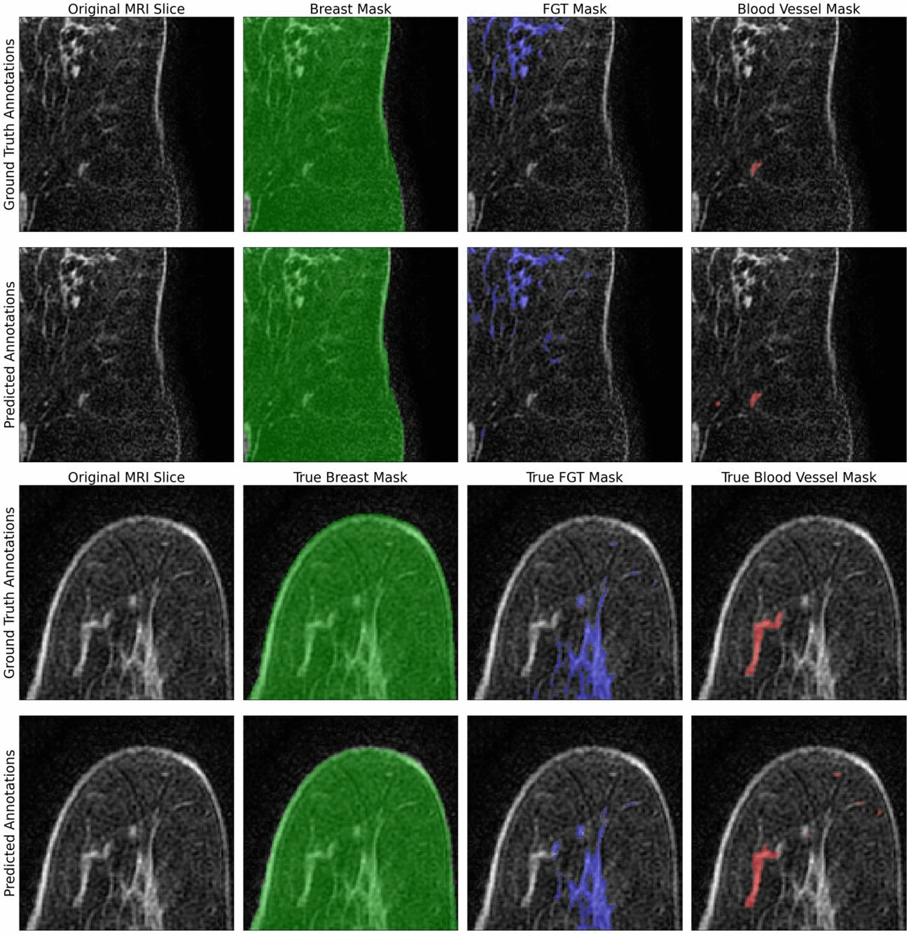 breast_mri_seg_dataset.png